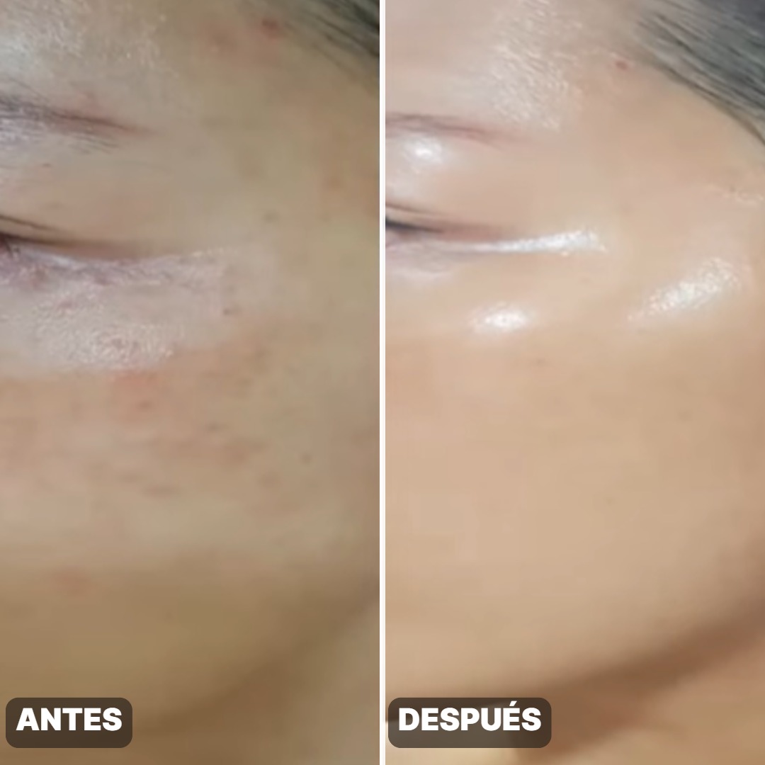 Antes y después — Piel de Porcelana