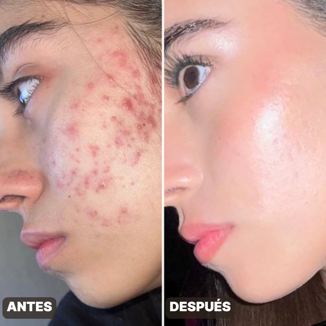 Antes y después — Resultados Reales